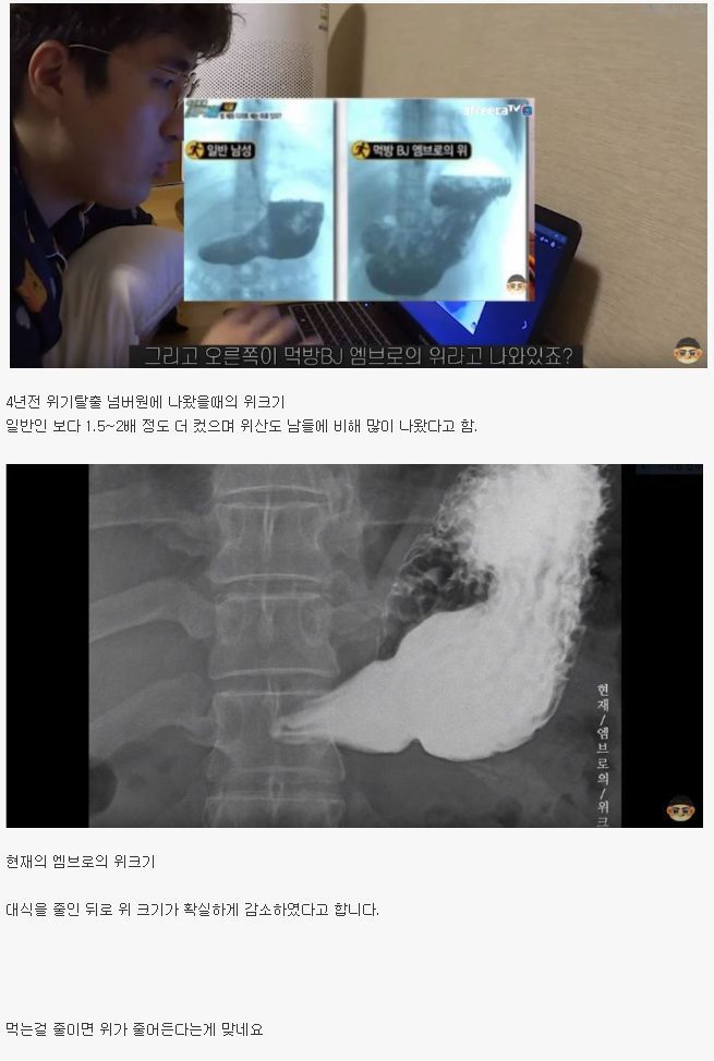 먹방 BJ 엠브로의 4년전과 현재의 위 크기 | 인스티즈